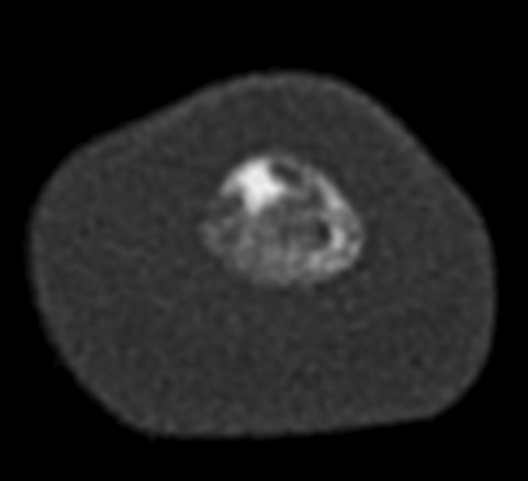 Figure 2 for case Osteoid osteoma ( RID4005 )